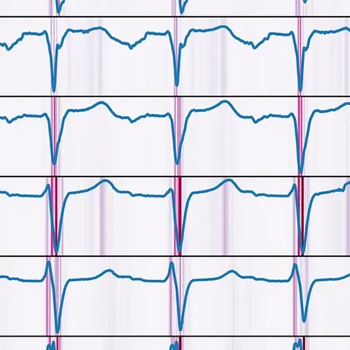 AI analysis for ejection fraction estimation from 12-lead ECG